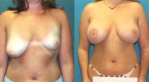 Breast Reduction Before & After