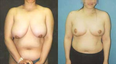 before and after breast reduction