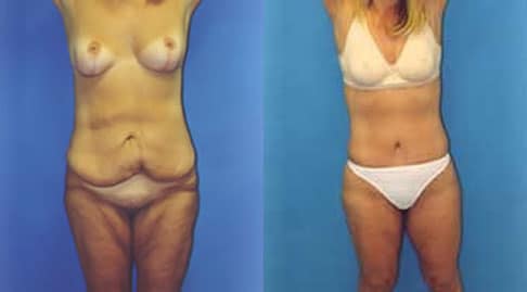 Tummy Tuck Actual Patient