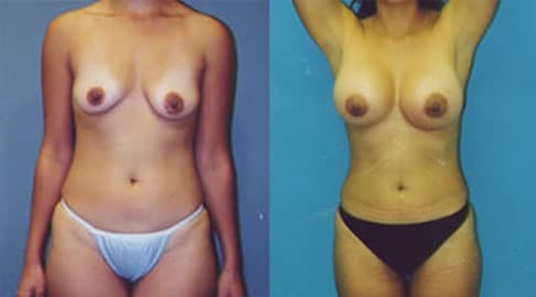 Liposuction Actual Patient