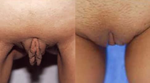 before and after labiaplasty