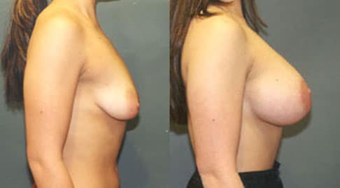 Breast Lift Actual Patient