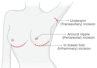 Breast Implant Incisions
