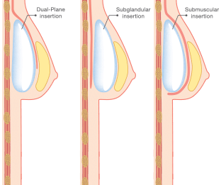 Breast Implant Placement Diagram