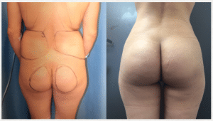 Butt Augmentation Before and After Photo