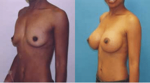 Breast Augmentation Before and After Photos - Dr. Robert Rey