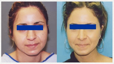 Rhinoplasty Before and After Photos