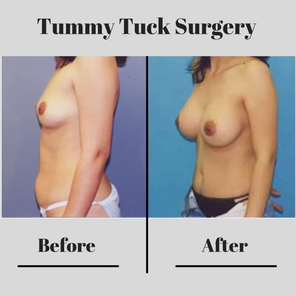 tummy_tuck6-tummy_tuck6-2-blog-ba-img