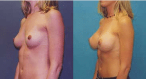 Before and After Breast Augmentation