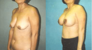 Before and After Breast Lift