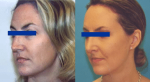 Before and After Rhinoplasty