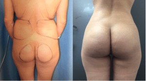 Before and After Butt Augmentation