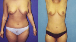 before-and-after-liposuction