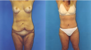 before-and-after-tummy-tuck