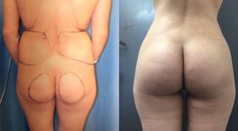 Butt Augmentation Actual Patient