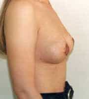 Breast Augmentation 109 Patient After