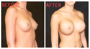 breast-aug-64-1.jpg-blog-ba-img