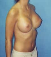 Breast Augmentation 87 Patient After