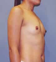 Breast Augmentation 89 Patient Before