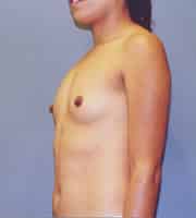 Breast Augmentation 90 Patient Before