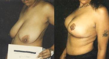 Breast Reduction Before and After Photos