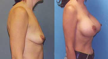 before and after lollicup and lift procedure
