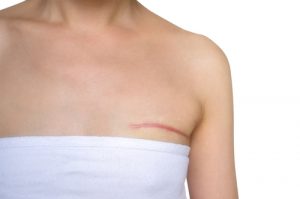 Scar Above Breast