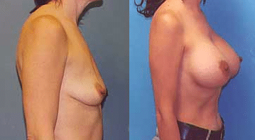 breast_lift1breast_lift2-img-blog