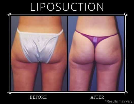 This before-and-after set shows the effect of liposuction in smoothing contours along a young woman's buttocks, hips, and thighs.