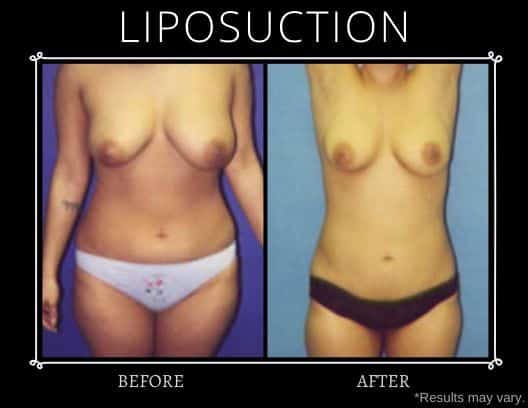 This before-and-after image set shows the effects of liposuction in smoothing a young woman's overall body contours.