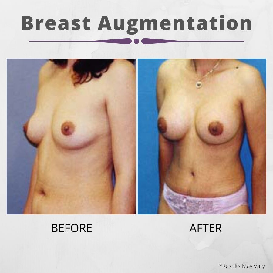 While recovering from breast surgery can take weeks, breast augmentation helps women get visibly fuller breasts, as seen in this before and after set.