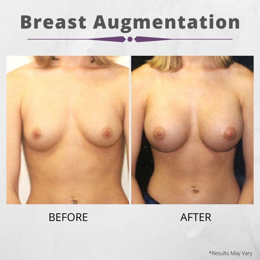 Preparing before your breast augmentation surgery can facilitate healing for beautiful, natural-looking results, like the before and after image set above.