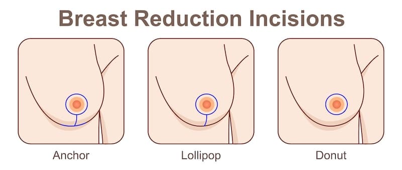 Illustration demonstrating the incision options available for breast reduction.