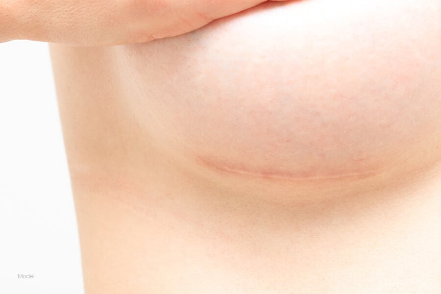 Woman showing her breast scar