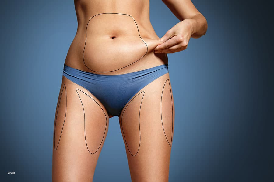 Woman with surgical markings on her body pinching excess fat on her belly